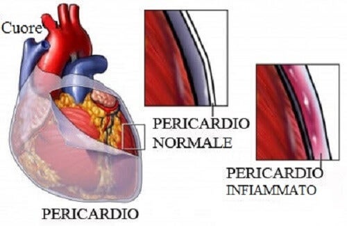 Salvucci Fabrizio pericardite