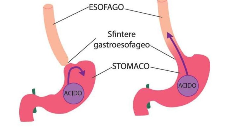 Salvucci Fabrizio reflusso gastroesofageo